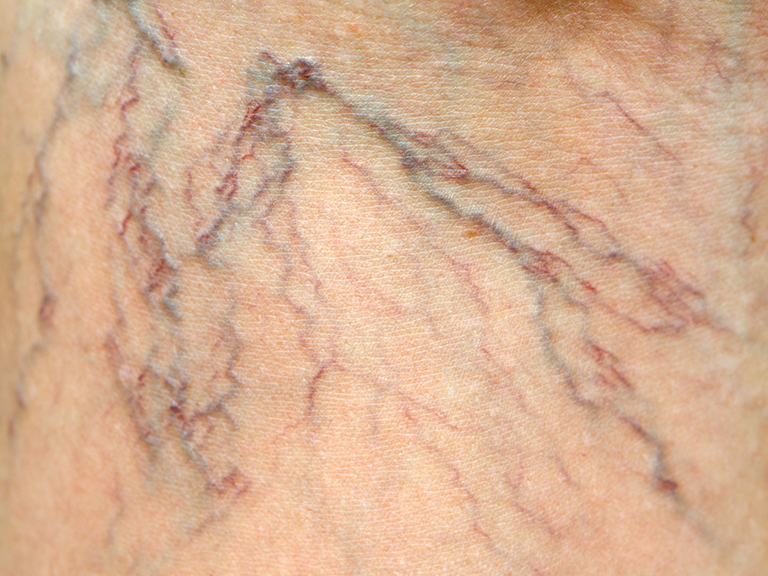 Spider Veins